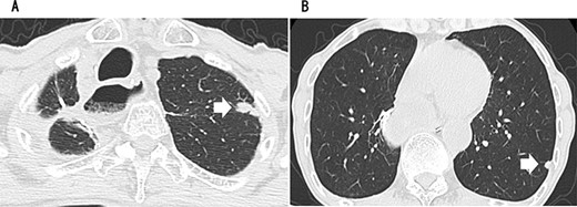 CT revealing a nodule measuring 1.5 cm at the apex of the left lung (A) and a nodule measuring 0.9 cm below the S9 pleura of the left lung (B).