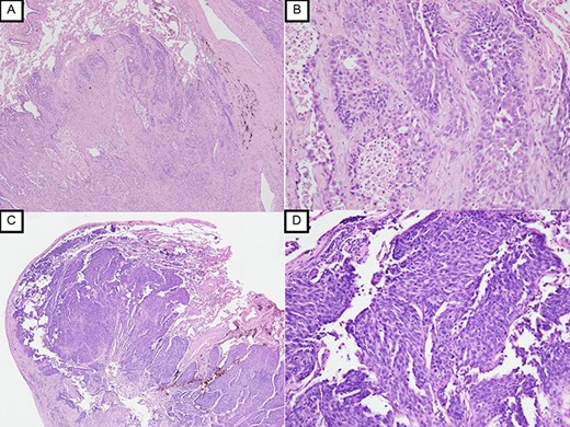 Histopathological examination with HE staining revealing squamous cell carcinoma in S1 + 2 nodule (original magnification ×20 (A), ×100 (B)); histopathological examination with HE staining revealing poorly differentiated squamous cell carcinoma in S9 nodule (original magnification ×20 (C), ×100 (D)).