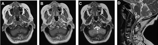 MRI findings of a ventral atlantoaxial degenerative cyst with an associated medullary syrinx; axial T1-weighted pre-contrast (A), axial T1-weighted post-contrast (B), axial T2-weighted (C) and sagittal T2-weighted (D) images demonstrate an approximately 1 × 1 cm T1-isointense, T2-hyperintense, rim-enhancing cyst at C1-2 compressing the ventral medulla with an associated a fluid-filled medullary syrinx.
