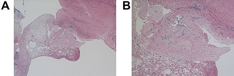 Light microscopy of the resected C1-2 cyst under ×40 (A) and ×100 (B) magnification; hematoxylin- and eosin-stained sections of cyst wall show benign fibroconnective tissue with degeneration but without epithelium or focal endothelial proliferation; GFAP, EMA, S-100, progesterone, CEA-M immunostains were negative.