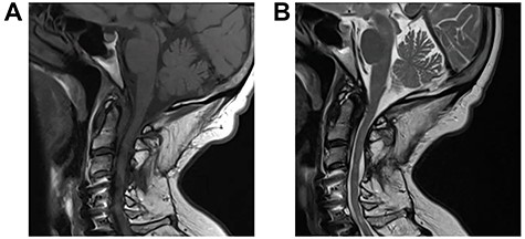 Repeat MRI 4 months post-minimal access far-lateral transcondylar approach for resection of the C1-2 degenerative cyst; sagittal T1-weighted (A) and T2-weighted (B) sequences demonstrate gross total resection of the cyst with complete resolution of the medullary syrinx.