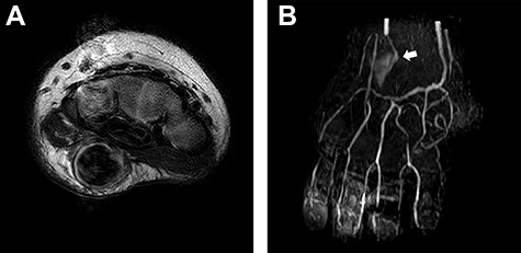 Presurgical images. (A) MRI revealed existence of a subcutaneous mass with the size of 9 x 9x 17 mm. (B) MR angiogram showed that the ulnar artery flow was reduced and deviated at the mass (white arrow). Continuity of the arterial network from the radial artery to the fingers was confirmed.