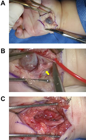 Surgical findings. (A) A subcutaneous mass was seen. (B) A vessel loop was put beneath the ulnar artery proximal to the mass. Adherence of the mass to the ulnar nerve (yellow arrow) was observed. (C) Soon after the resection of the mass. The ulnar nerve was preserved.