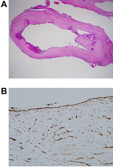 Histologically, it was diagnosed as a true aneurysm. (A) The aneurysm was sliced. Vascular lumen was maintained. All three layers of the arterial wall: tunica intima, media and adventitia were confirmed (Haematoxylin and eosin stain, 1.25x objective lens). (B) Lining of the lumen with endothelial cells was confirmed. Endothelial cells of vasa vasorum were also stained (CD31 stain, 20x objective lens).