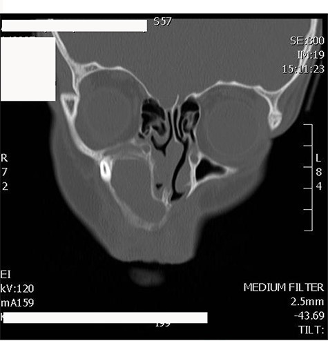 CT scan of maxillofacial bones showing a large expansible cystic lesion in the right maxillary bone that arises from the maxillary alveolar ridge with superior extension and displacement of the right maxillary sinus as well as remodeling of the floor of the right orbit with slight narrowing of the right inferior orbital fissure.