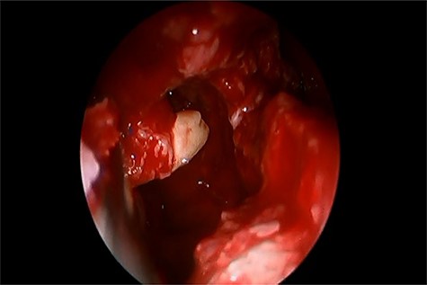 Inferior meatal antrostomy, after sac enucleation, while removing the tooth.