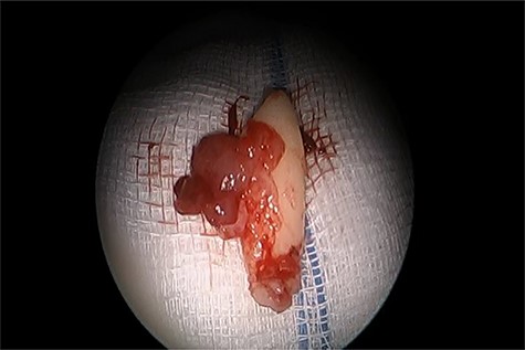 The ectopic tooth after removal.