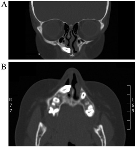 (A, B) CT of the paranasal sinuses (coronal and axial view) revealing displaced right upper maxillary tooth with the crown-oriented inferiorly and medially toward and within the lower right anterior nasal cavity.