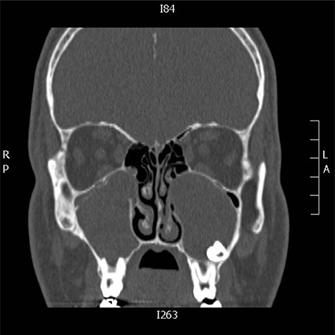 CT scan of the paranasal sinuses showed bilateral ectopic teeth and cystic lesions within both of the maxillary sinuses.
