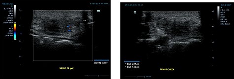 Ultrasound examination demonstrating a heterogenous lesion measuring 2.9 × 2.3 × 1.4 cm mass.