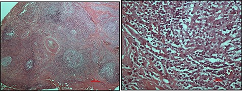 Haematoxylin and eosin-stained micrographs of the mass depicting reactive lymphoid follicles in a fibrous stroma magnification ×4 (A) and eosinophilic infiltration at magnification ×40 (B).