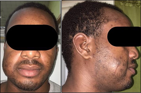 Anterior (A) and right lateral (B) photographic views depicting the diffuse 5.0 × 5.0 cm swelling to the right cheek (surgical scar from initial excision highlighted) in this Jamaican man.