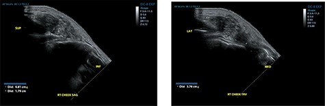 Ultrasound examination demonstrating a heterogenous lesion measuring 4.8 × 3.8 × 1.8 cm mass.