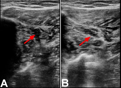 Ultrasound of the right lower extremity within the anterior peroneal vein prior to compression (A) and with compression (B). Incomplete compression of the vein is suggestive of DVT as indicated by the red arrows.