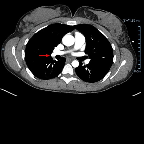 Chest CTA demonstrating filling defect within the right lower lobar pulmonary arterial vasculature consistent with pulmonary embolus as indicated by the red arrow.