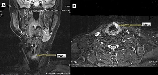 MRI. (A) Coronal and (B) axial, STIR image demonstrating hyperintense mass lesion (arrow pointing) within the isthmus extending into the left thyroid lobe.