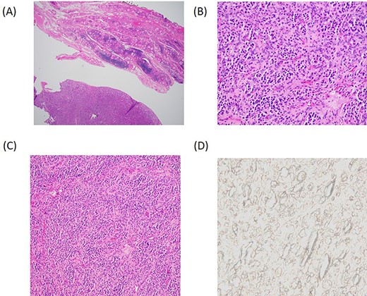Histopathology. (A) Low power magnification depicting a vaguely lobular proliferation of round cells adjacent to benign thyroid parenchyma. (H&E, 4×). (B) Higher power magnification demonstrating the nested arrangement of PG with a round to oval cells and eosinophilic cytoplasm set within a highly vascularized stroma. (H&E, 20×). (C) Zellballen pattern; a characteristic feature of PG (H&E, 10×). (D) Negative SDH-B immunostain suggests the familial or hereditary nature of the PG.