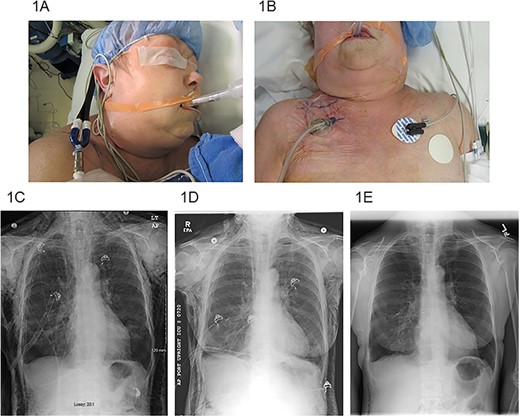 (A) SE extending to the periorbital region, (B) right infraclavicular incision location with VAC dressing, (C) pre-operative chest X-ray, (D) chest X-ray post-operative day #3 after VAC placement and (E) chest X-ray post-operative day #22 after VAC placement.