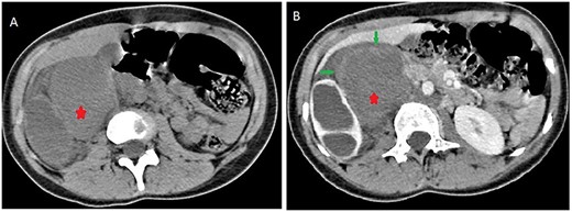 Abdominal CT scan showing a retroperitoneal mass; retroperitoneal ganglioneuroma (red spark) before (A) and after (B) heterogeneous enhancement (green arrow).