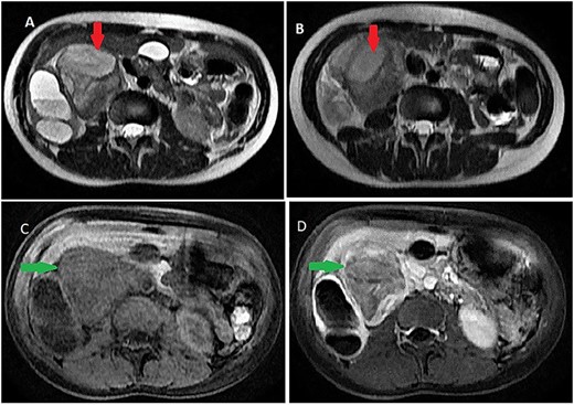 Abdominal MRI showing a retroperitoneal mass; (A and B) axial T2-weighted images show heterogeneous high signal in the lesion; (C and D) axial T1-weighted image, before (C) and after (D) dynamic sequences with contrast showing a delayed heterogeneous enhancement with some septa and areas of necrosis within the mass.