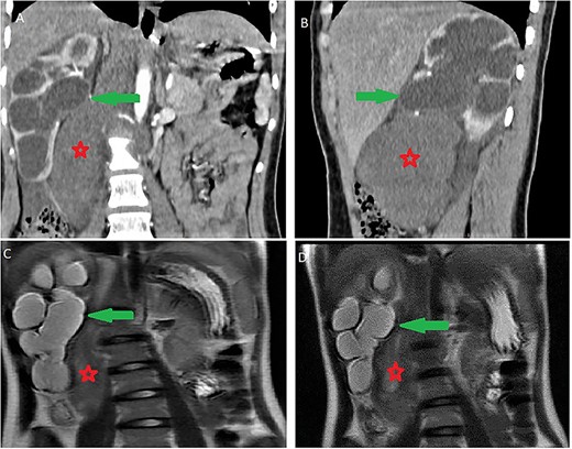 Ureterohydronephrosis due to the mass effect; ureterohydronephrosis (green arrow) due to the mass effect (red spark) on coronal (A), sagittal (B) Ct scan and coronal MRI T2-weighted image (C and D).