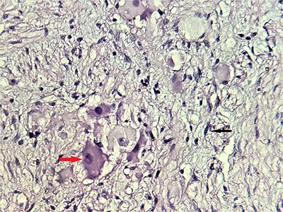 Microscopic scrutiny of the resected specimen; the observed ganglion cells (red arrow) are mature, having a compact, eosinophilic cytoplasm and a single eccentric nucleus with prominent nucleolus; Schwann cells (black arrow) are also mature—HE;400X.