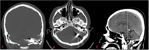 Computed tomography (bone window: A: coronal, B: axial) reveals metallic object located between left occipital bone and inferior side of left cerebellar hemisphere; CT (brain window C: sagittal) shows hemorrhage along its trajectory.