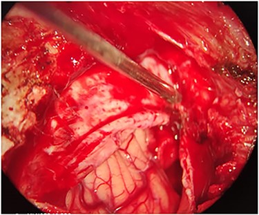 Intra-operation image shows the contused brain tissue which was caused by bullet in left cerebellar hemisphere.