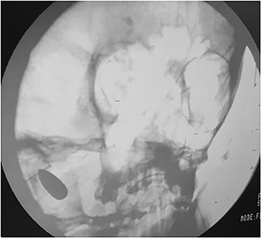 Intra-operation skull X-ray revealed that bullet had inversed and migrated upwards inside the left cerebellar hemisphere.