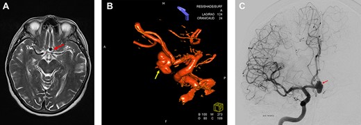 Preoperative neuroimaging. (A) MRI T2-weighted sequence shows an Acom aneurysm without thrombosis. (B, C) Digital subtraction angiography shows a multi-lobulated Acom aneurysm approximately sized 13.0 × 7.5 mm. (B) 3D Digital subtraction.
