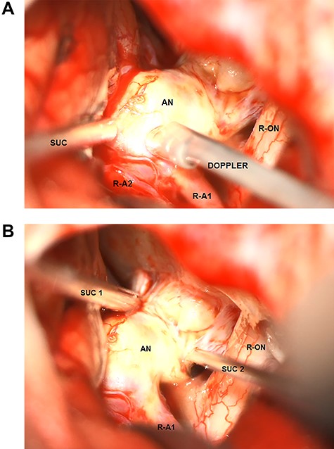 Intraoperative microscopic transsylvian view of the aneurysm. (A) Intraoperative microscopic transsylvian view of the aneurysm after the failed attempt to compress the calcified aneurysm with two suction devices (AN = aneurysm, R-ON = right optic nerve, SUC = suction, and R-A1 = right anterior cerebral artery). (B) Intraoperative microscopic transsylvian view of the aneurysm showing the assessment of the flow inside the aneurysm by means of micro-Doppler examination after temporary clipping of the right A1 segment. (AN = aneurysm, R-ON = right optic nerve, SUC = suction, DOPPLER = micro-Doppler, R-A1 and R-A2 = right anterior cerebral arteries).