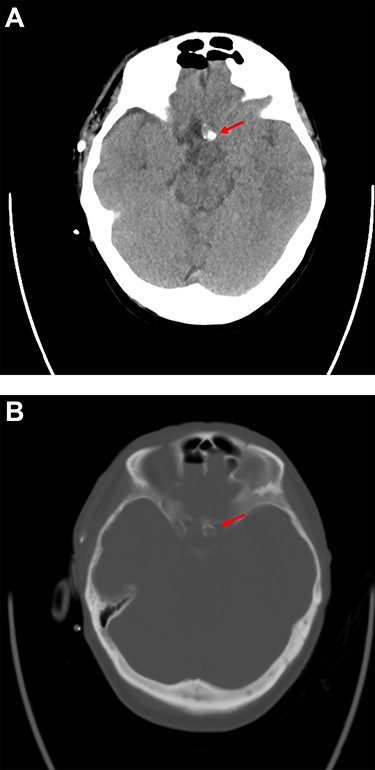 Postoperative computer tomography (A. soft tissue window, B. bone window) shows calcification of the aneurysm neck and dome with adherence to the skull base at the level of the tuberculum sellae.