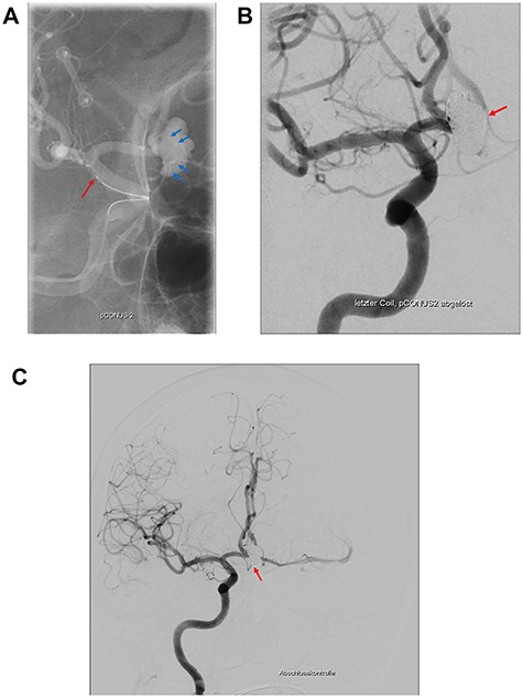 The pCONus2 device for the treatment of a calcified aneurysm of the Acom. (A) Digital subtraction angiography showing the placement of the pCONus2 bifurcation stent with its petals being located at the level of the aneurysm neck and the proximal stent ending at the distal segment of the internal carotid artery. (B) The implantation of several coils with a second micro_catheter navigated through the already opened pCONus. (C) Postprocedural digital subtraction angiography showing the completely occluded aneurysm with preservation of the Acom.