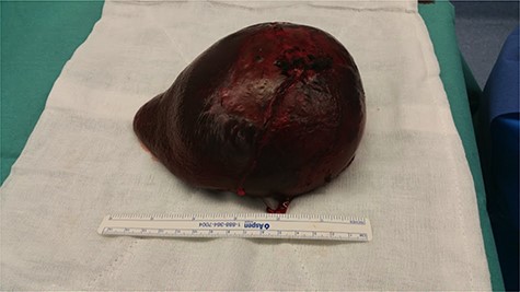 Macroscopic splenectomy specimen.