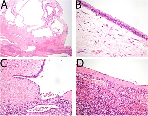 (A) Cyst wall demonstrated typical features of ovarian type serous cystadenoma composed of bland serous epithelial cells overlying ovarian type stroma. (B) Epithelial cells show typical serous features including cuboidal cytology and ciliation. (C) Ovarian type stroma merging with areas of splenic epithelial cyst with attenuation of the epithelium and loss of cilia. (D) Majority of the cyst shows typical features of a splenic epithelial cyst.