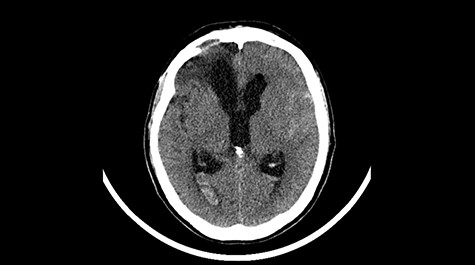 Head CT after polypectomy—presence of blood in fluid spaces, widening of the ventricular system, presence of air in the frontal horns of the lateral ventricles, features of cerebral edema. (Department of Neurosurgery Neurotraumatology and Pediatric Surgery own material).