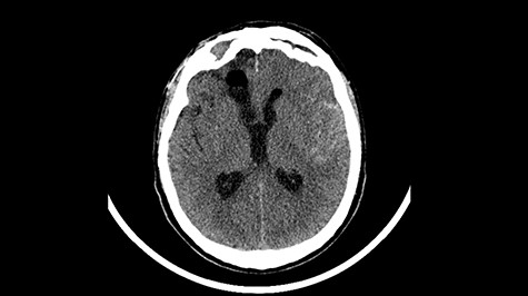 Head CT—state before VP shunt implantation. (Department of Neurosurgery own material).