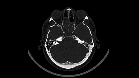 Head CT after polypectomy—seen defects of the upper left orbital wall. (Department of Neurosurgery own material).