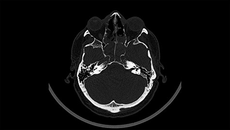 Head CT after polypectomy—seen sphenoid sinus and both maxillary sinuses filled with blood. (Department of Neurosurgery own material).