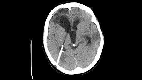 Head CT—state after VP shunt implantation. (Department of Neurosurgery own material).