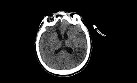 Head CT—seen absorption of air above the right orbital, the image without features of fresh bleeding, a slightly narrower ventricle. (Department of Neurosurgery own material).