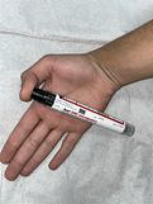 Appearance of the right thumb at presentation.