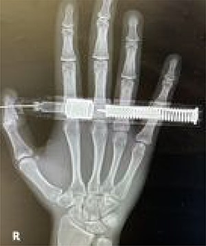 Posteroanterior view of the embedded needle on the right distal phalanx of thumb.