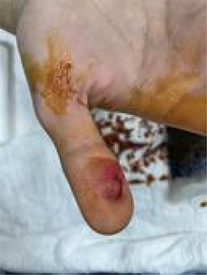 After needle removal under sterile condition.