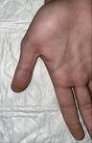 On follow-up, 7 days after the accident. The wound had healed completely.