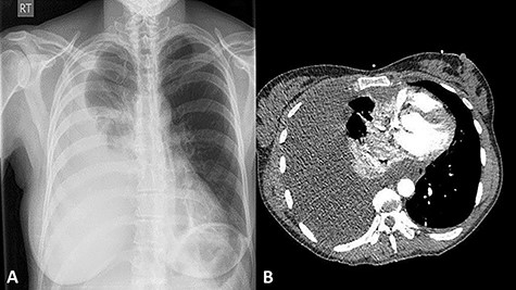 A postero-anterior plain CXR showing a large right-sided pleural effusion (A); a contrast-enhanced CT scan showing large right-sided pleural effusion causing right lung collapse and left mediastinal shift with compression of the right atrium; note the intact ribs and vertebra (B).