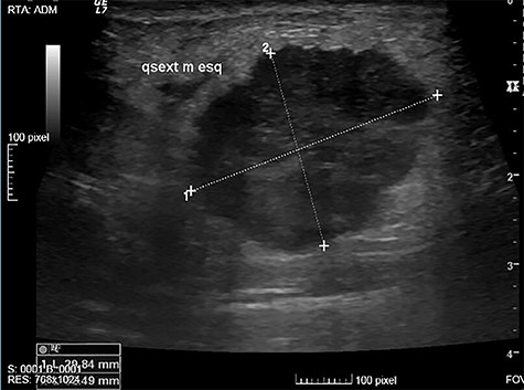 Suspicious nodule of 25 mm, in the UEQ of the left breast on breast US.