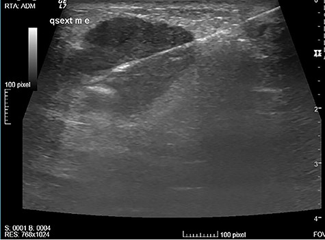 US-oriented wire positioning to guide the quadrantectomy.