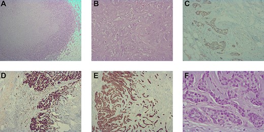 (A) histological image (hematoxylin–eosin staining, 40×) showing the trabecular and cordonal peripherical component; (B) histological image (hematoxylin–eosin staining, 200×) showing the mature chondroid central component. (C) immunohistochemistry image (100×) showing a heterogeneous and weak positivity for GATA3 in the peripherical component; (D) immunohistochemistry image (100×) showing a high positivity for Ki67; (E) immunohistochemistry image (100×) showing positivity for CK 7 in the peripherical component and (F) histological image (hematoxylin–eosin staining, 400×) showing a moderate nuclear pleomorphism with figures of mitoses in the trabecular and cordonal peripherical components.