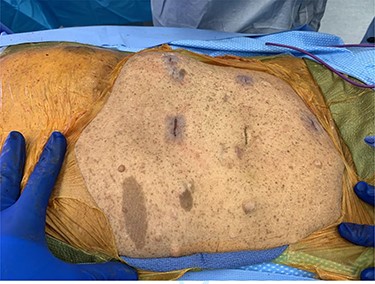 Diffuse cutaneous neurofibromas and ‘café-au-lait’ spots.